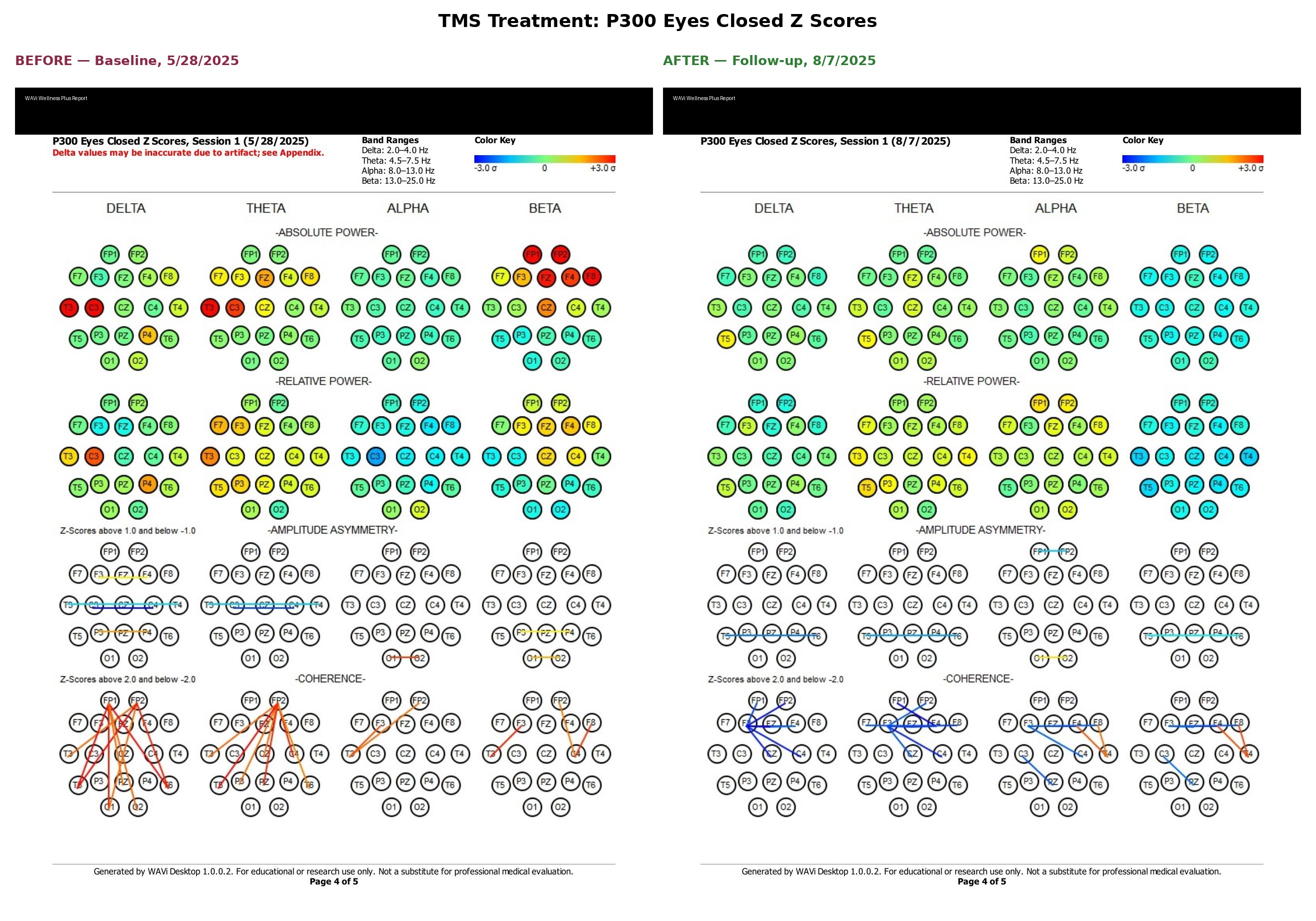 Brain scan comparison before and after TMS treatment